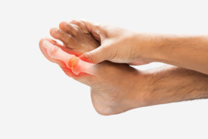 Gout Attacks | Aaria Rheumatology Gout Attacks