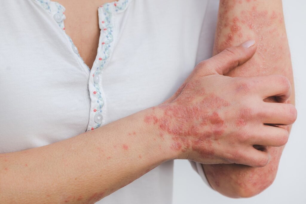 patient with psoriasis