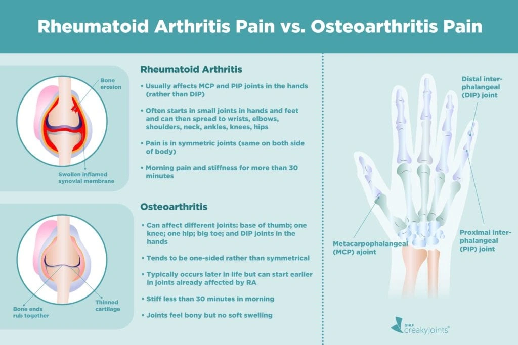 0223a67b-2500-47ee-b191-8033806d0fdc | Aaria Rheumatology Differentiating rheumatoid arthritis from osteoarthritis