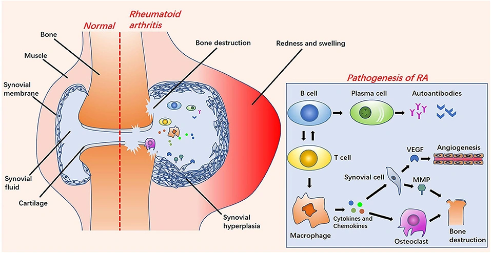 Pathogenesis of Rheumatoid Arthritis