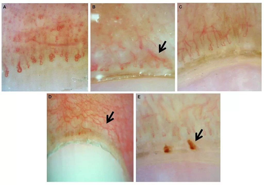 nailfold capillaroscopy images
